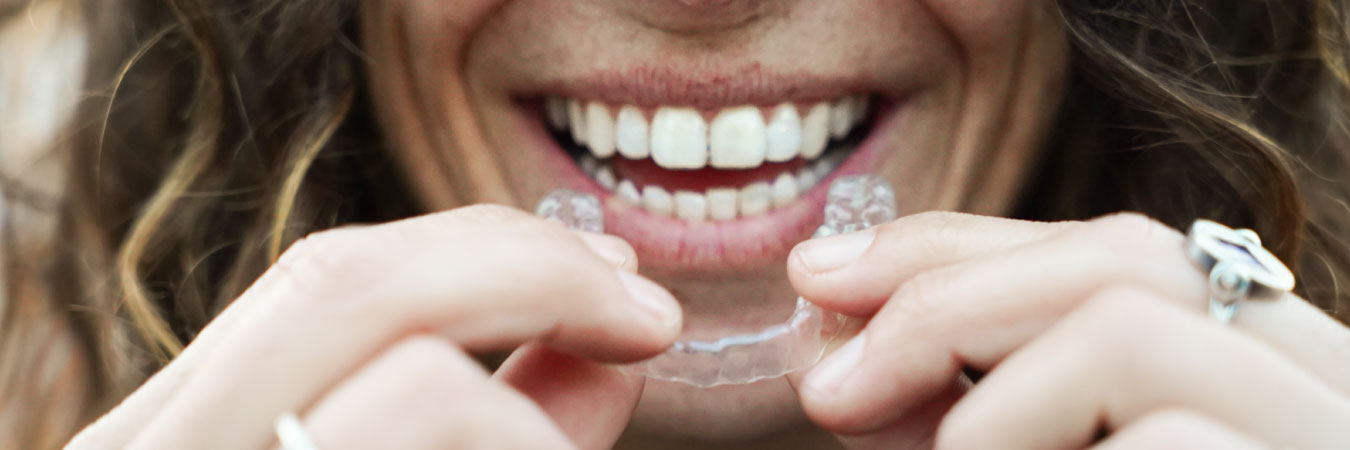 Ortodoncia invisible: alinea tus dientes sin que se note (y disfruta del verano)